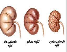 پاورپوینت نارسایی کلیه