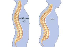 اسلاید آموزشی با عنوان موضوع تحقیق پشت گرد(کیفوز پشتی)