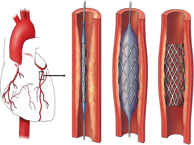 پاورپوینت  Stent(استنت)