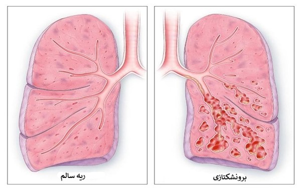 دانلود پاورپوینت تشخیص و درمان بیماری برونشکتازی