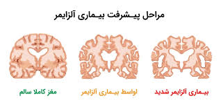 پاورپوینت بیماری آلزایمر