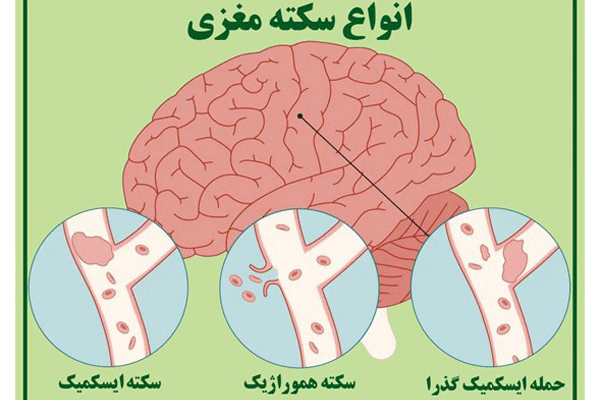 پاورپوینت در مورد سکته مغزی