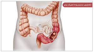 دانلود پاورپوینت تشخیص بیماریهای روده ای